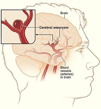 Аневризма головного мозга